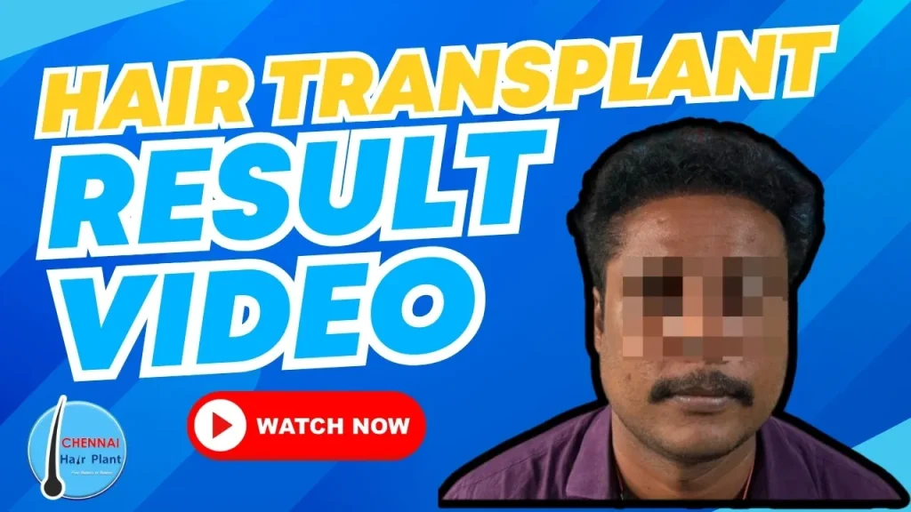 Just 1 Hair Transplant Result video changed my life. Chennai Hair Plant. Best solution for hair transplant