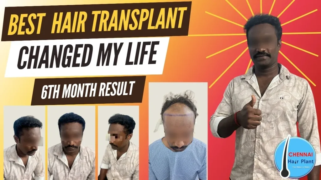 6th Month Hair Transplant Result best hair transplant clinic