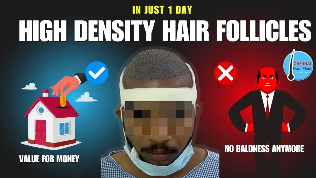 HIGH DENSITY OF HAIR IMPLANTATION hair transplant at high density