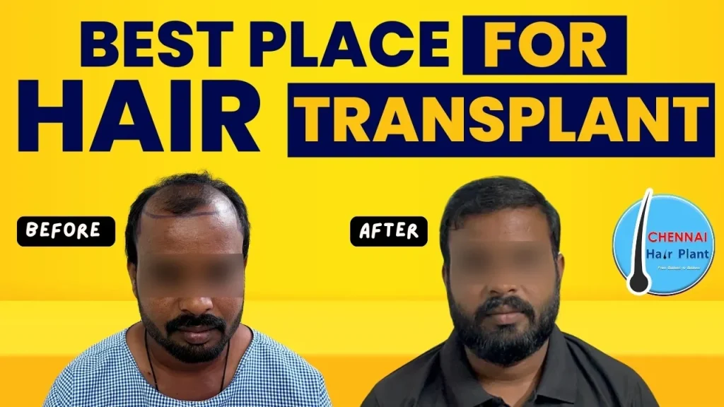 Best Place for Hair Transplant Hair Transplant result best clinic hair transplant