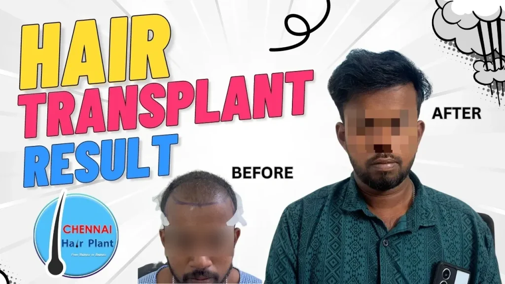 Hair Transplant Result best hair transplant clinic