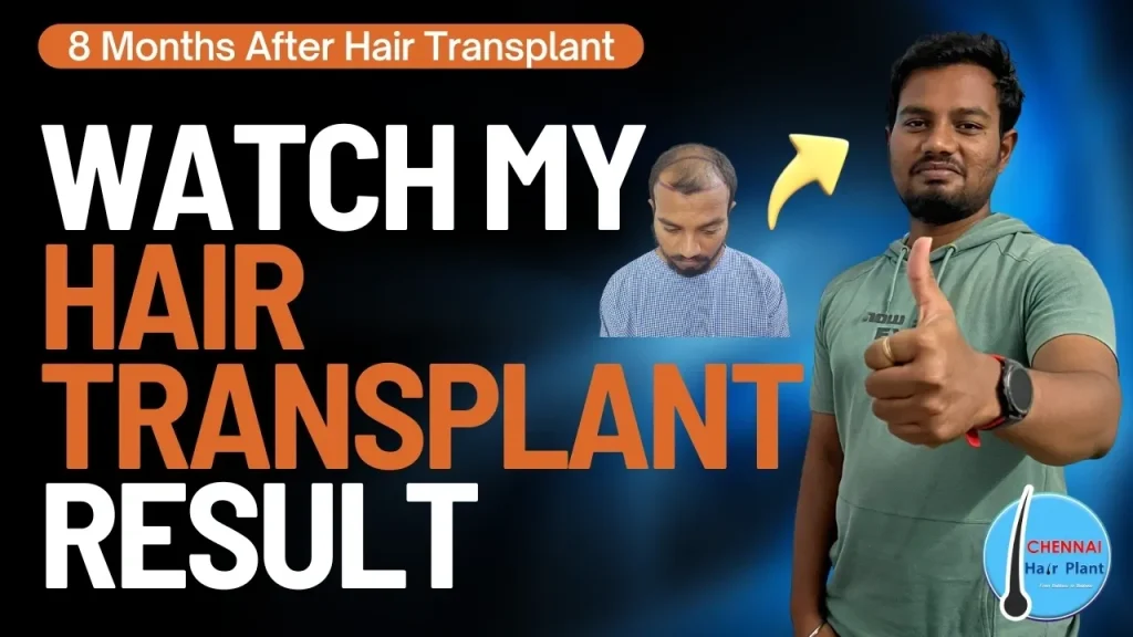 Hair transplants chennai best hair transplant clinic