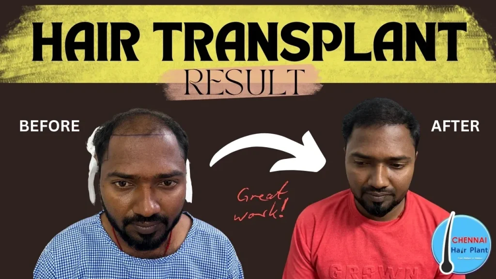 Hair Growth in just 5 months ! No More Baldness hair transplants chennai