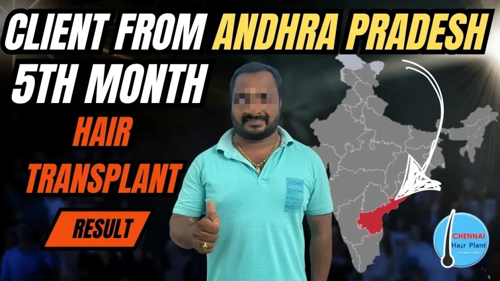 Client from Andhra Pradesh hair transplant result