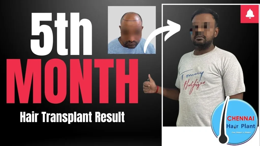 Hair Transplant surgery result