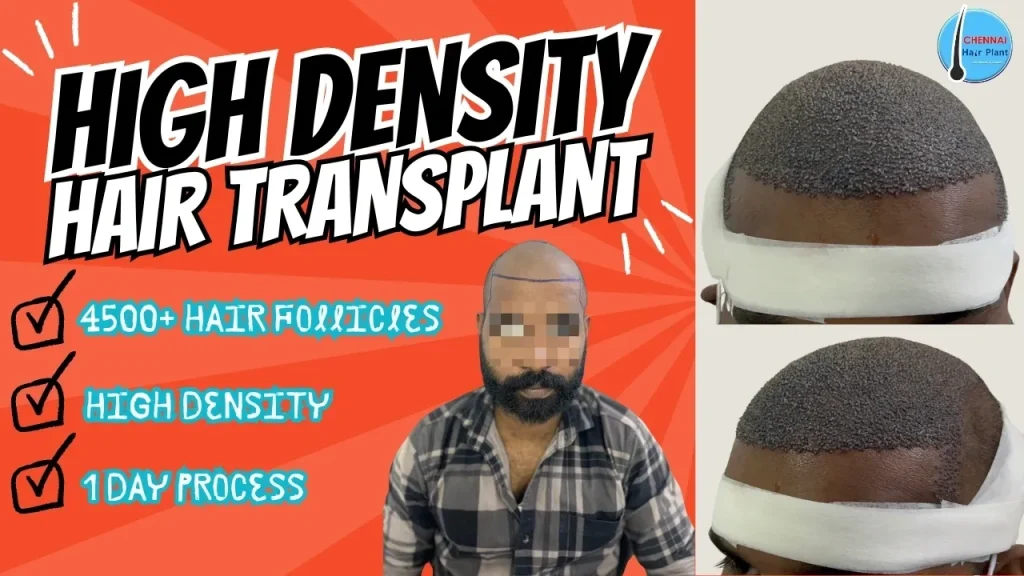 Hair Transplant @ High density ! best hair transplant clinic