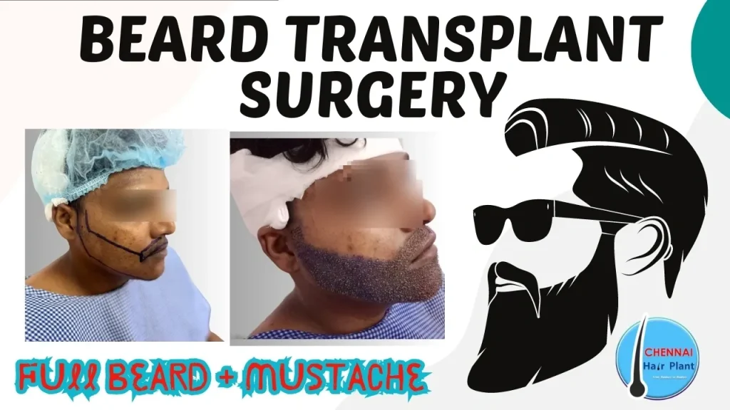 What is the cost of full Beard Transplant ? how to grow beard faster in 7 days