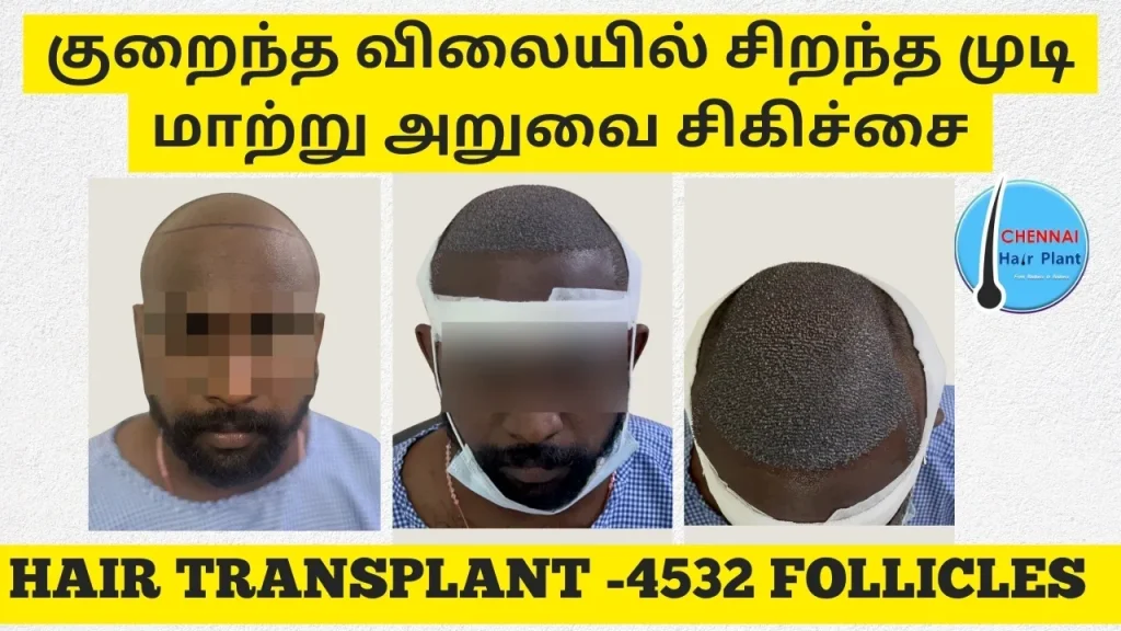 குறைந்த விலையில் சிறந்த முடி மாற்று அறுவை சிகிச்சை hair transplant offer hair transplant diwali offer