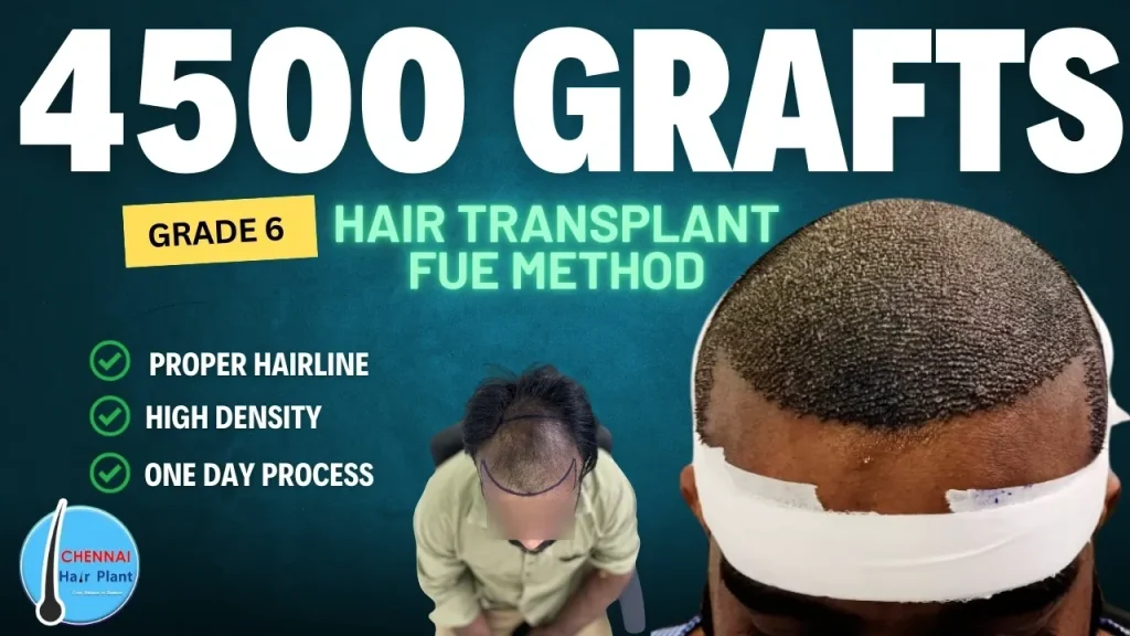 High Density Hair transplant in 1 day best hair transplant clinic