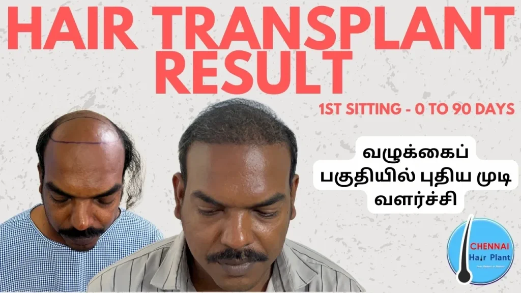 வழுக்கைப் பகுதியில் புதிய முடி வளர்ச்சி hair loss treatment for men