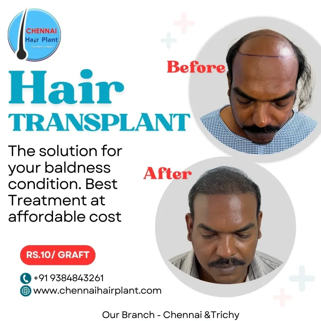 Hair Transplant @ 25k to 45K only best hair transplant clinic