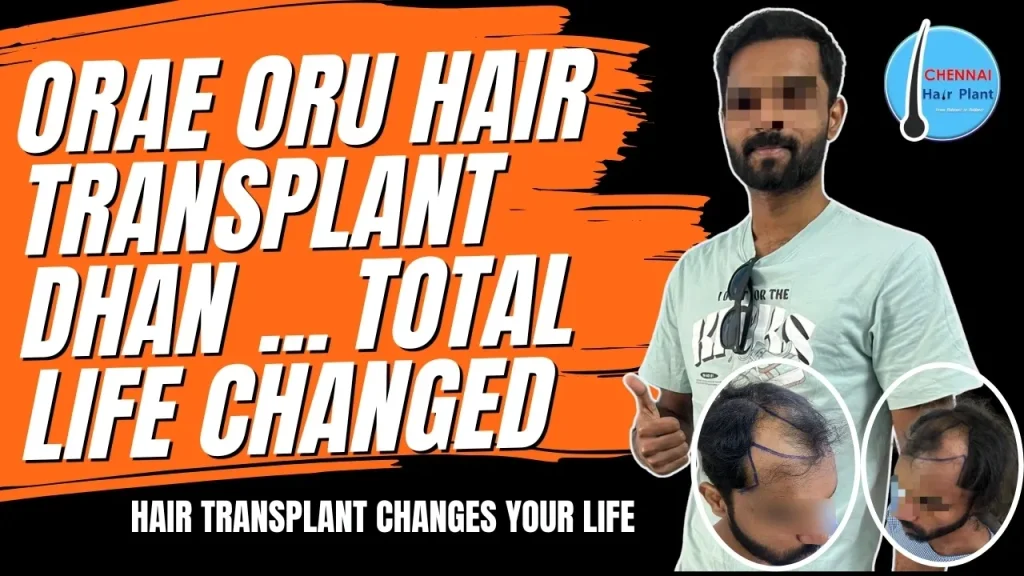 1 Hair Transplant Surgery Changed my entire Life ! best hair transplant clinic
