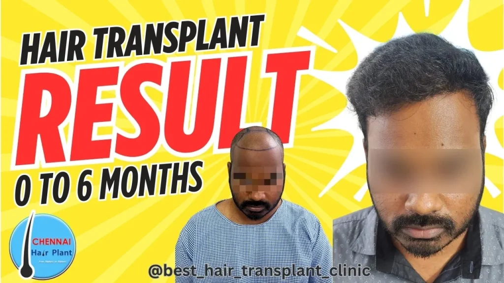 Perfect Hair Transplant Result ! best hair transplant result