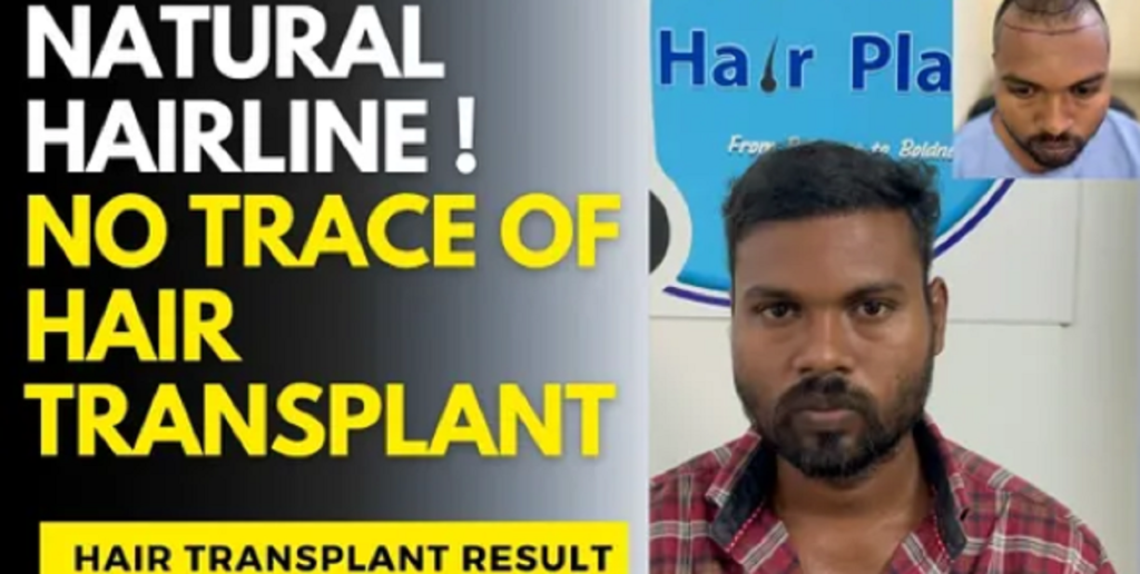 No trace of Hair Transplant hair transplant result