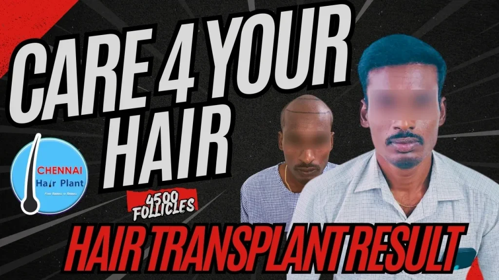 Care for your Hair ! best hair transplant clinic