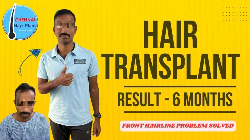 Front Hairline correction – 4683 follicles hair transplant result