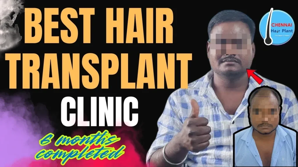Best Hair Transplant Clinic Hair Transplant result