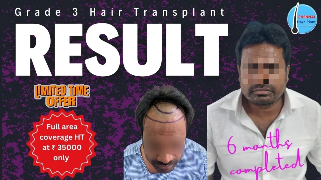 Grade 3 Result best hair transplant clinic
